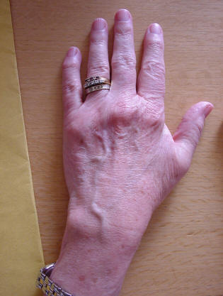Arthritis hand